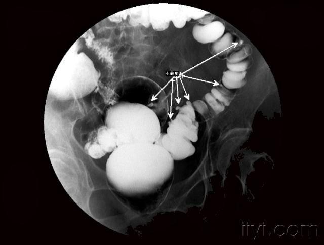 结肠多发憩室 - 医学影像学讨论版 - 爱爱医医学论坛