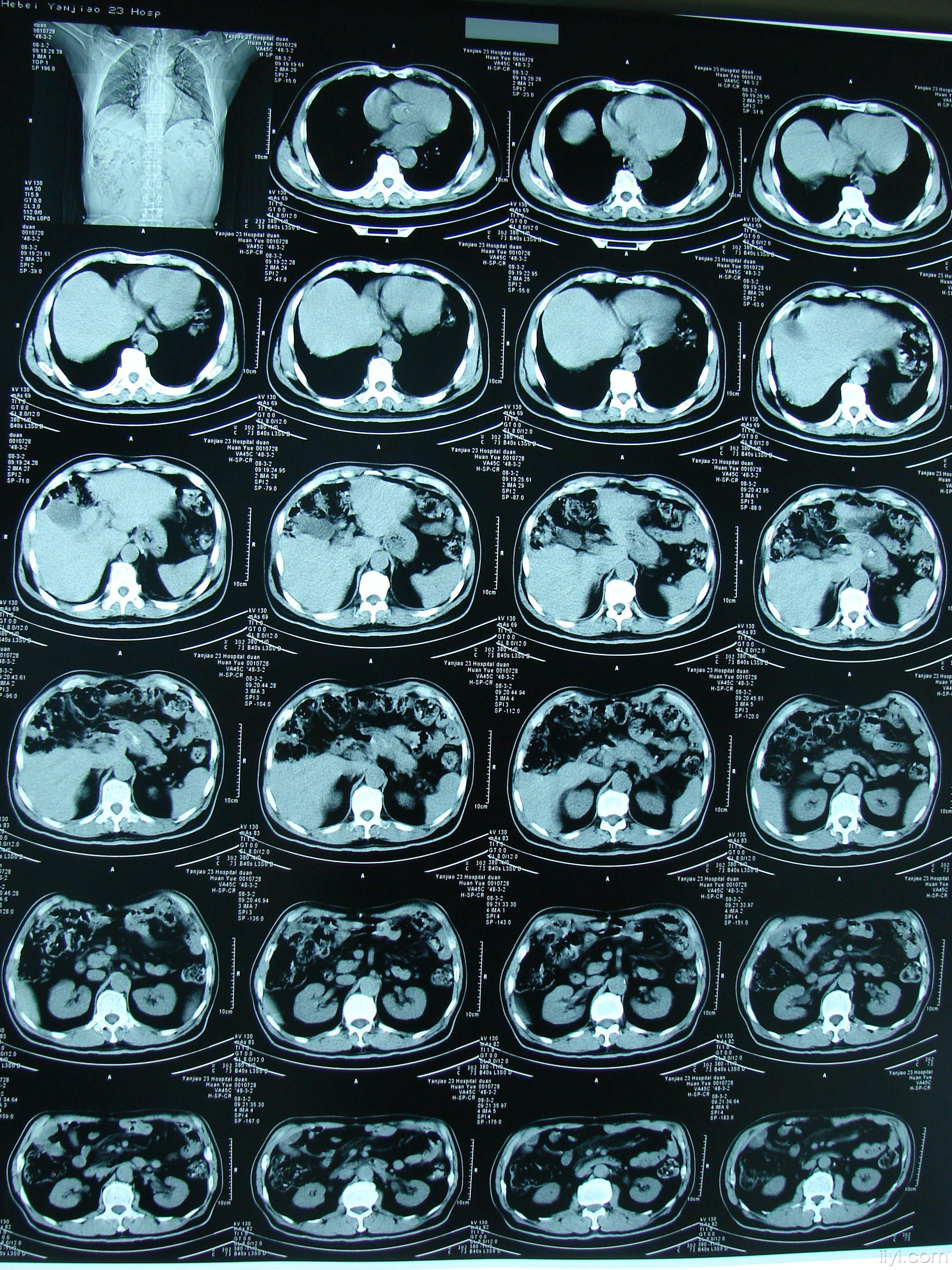 腹部ct