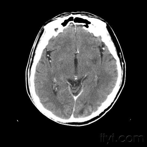 头颅ct平扫 增强