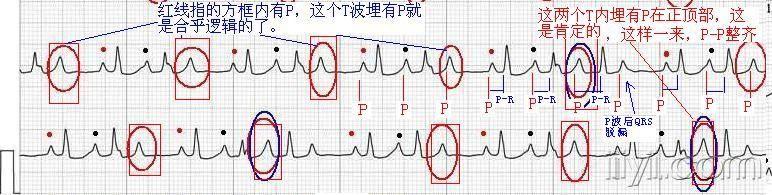 室内差异性传导? - 心电图脑电图专业讨论版