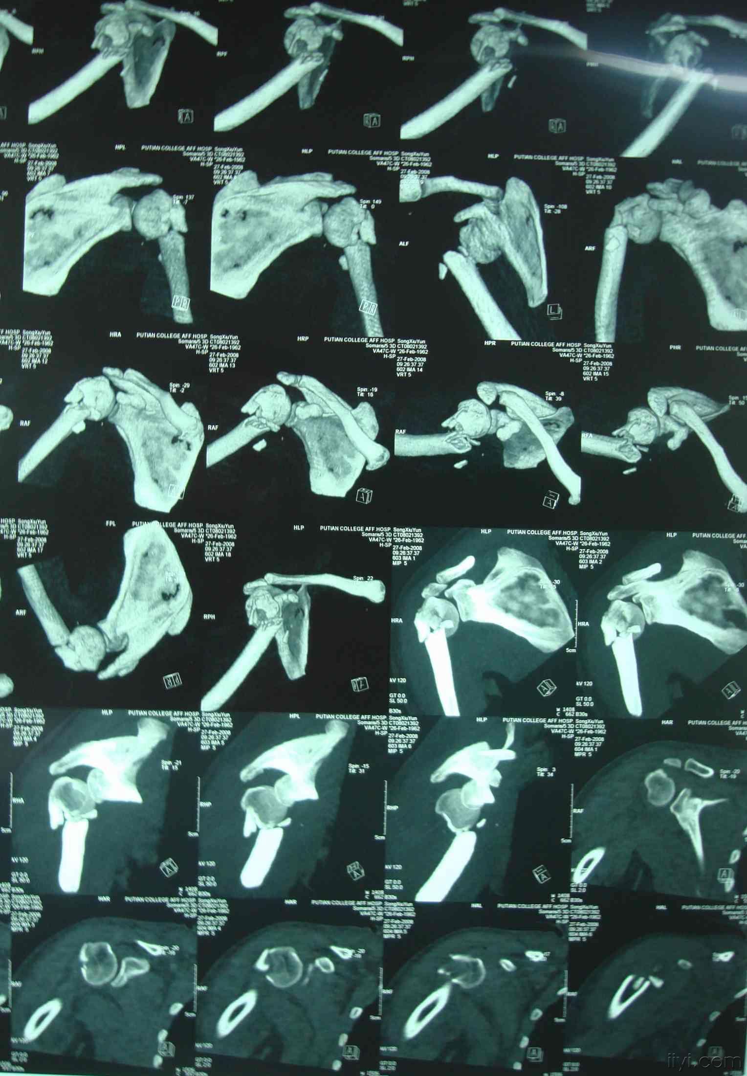 病例讨论一例做了ct三维重建的右肱骨外科颈骨折
