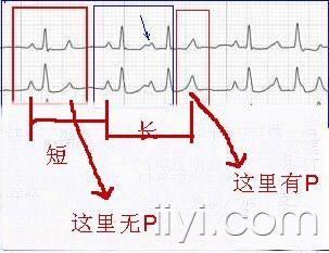 室内差异性传导? - 心电图脑电图专业讨论版