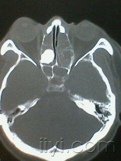 右侧筛窦骨瘤