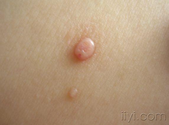 传染性软疣(molluscum contagiosum 传染性软疣俗称水瘊子,系痘病毒