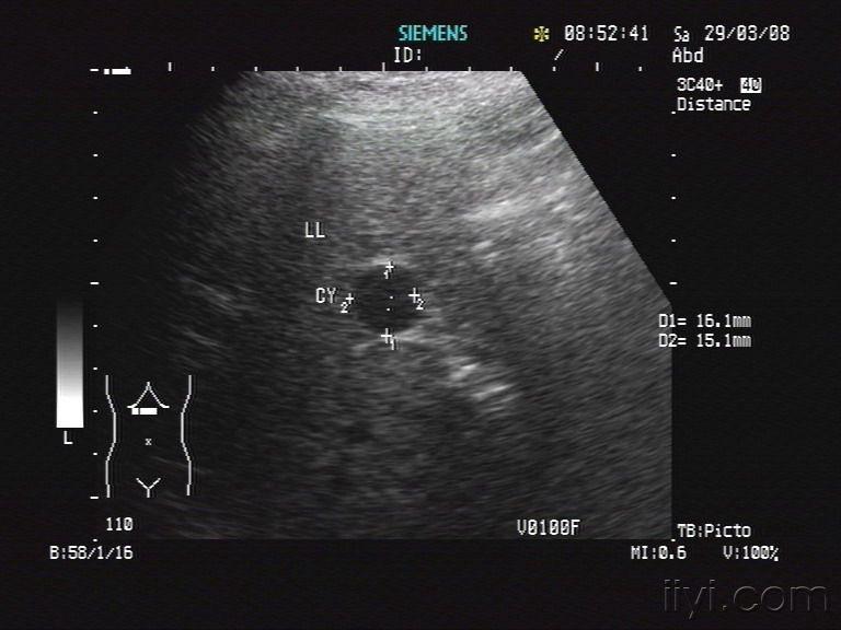 一例"肝囊肿"的诊断 - 超声医学讨论版 - 爱爱医医学