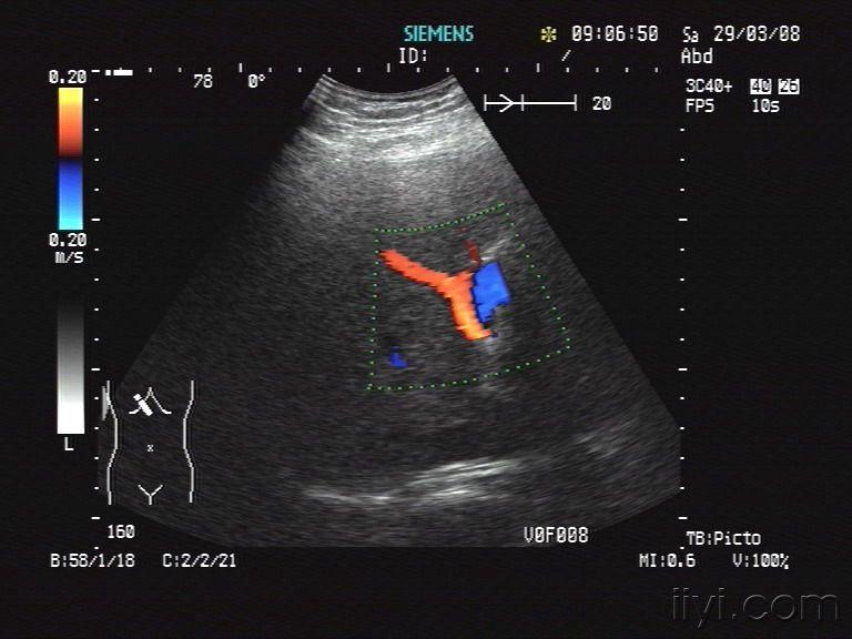 一例"肝囊肿"的诊断 - 超声医学讨论版 - 爱爱医医学