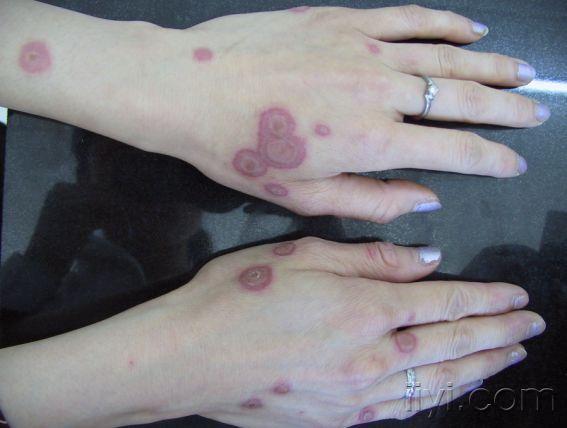 多形红斑是一种急性炎症性皮肤病,典型皮损为虹膜样或靶形红斑,常