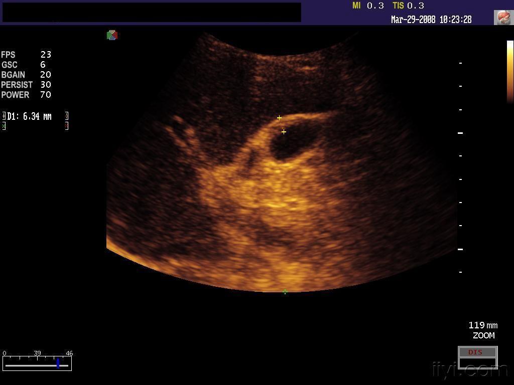 胆囊炎 - 超声医学讨论版 - 爱爱医医学论坛