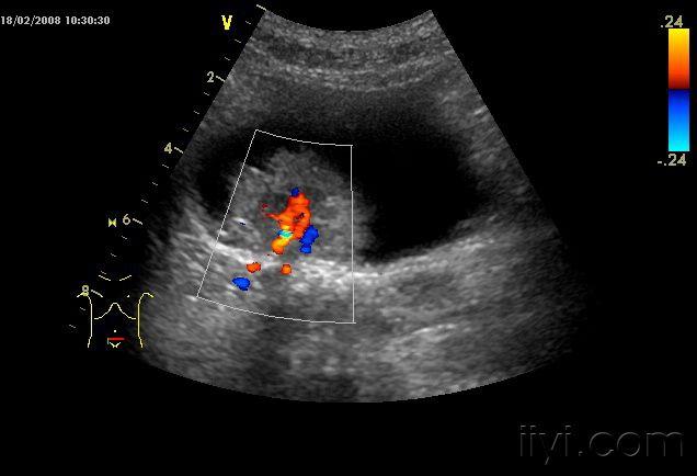 典型膀胱癌声像图一例 超声医学讨论版 爱爱医医学论坛