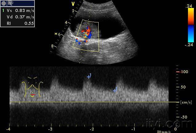 典型膀胱癌声像图一例 超声医学讨论版 爱爱医医学论坛