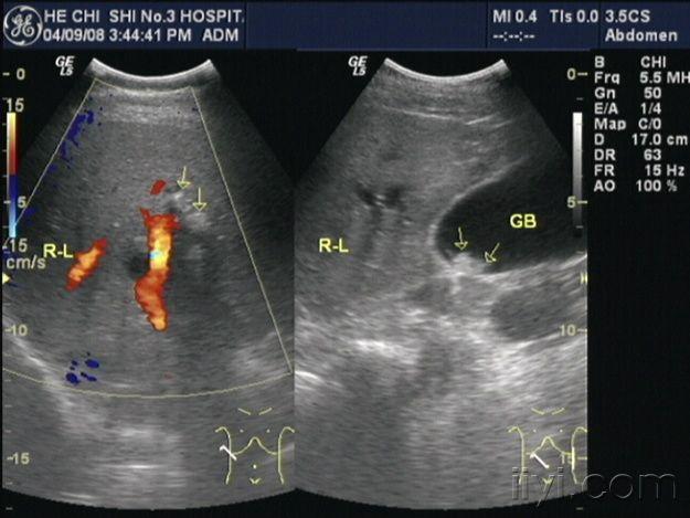 胆囊结石,胆总管结石 - 超声医学讨论版 - 爱爱医医学