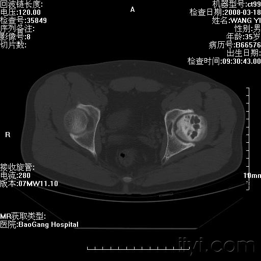 股骨头坏死的cr和ct表现