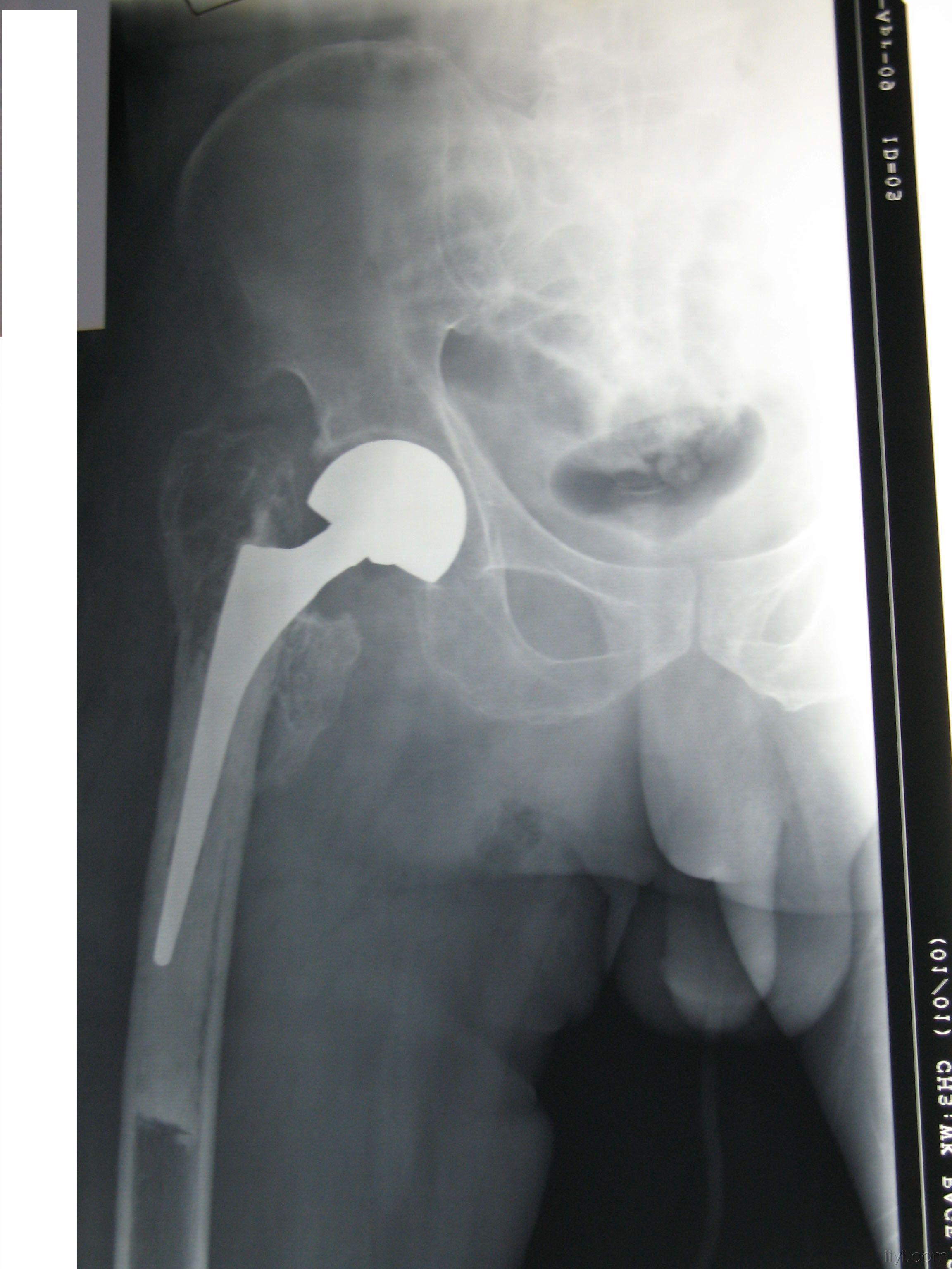 股骨粗隆间骨折畸形愈合股骨头置换术后