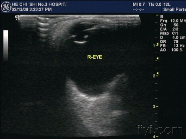 视网膜脱离声像 - 超声医学讨论版 - 爱爱医医学论坛