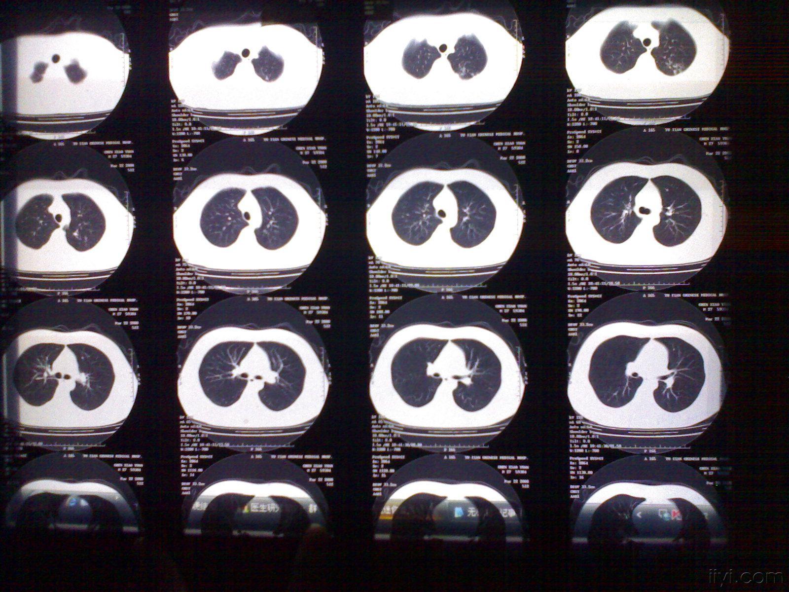 肺部dr大家看下更新了dr和ct