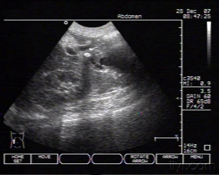 胆总管结石 - 超声医学讨论版 - 爱爱医医学论坛