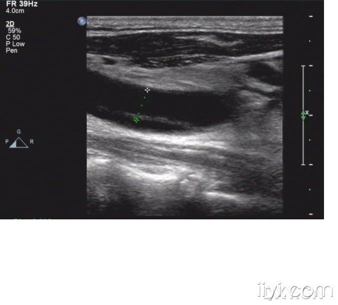 主动脉夹层 - 超声医学讨论版 - 爱爱医医学论坛
