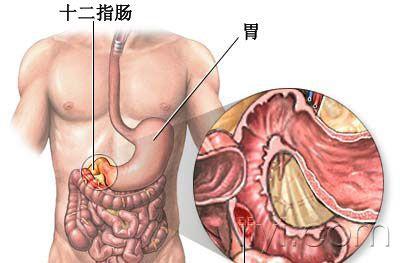 急性上消化道大出血一例 - 消化内科讨论版 - 爱爱医