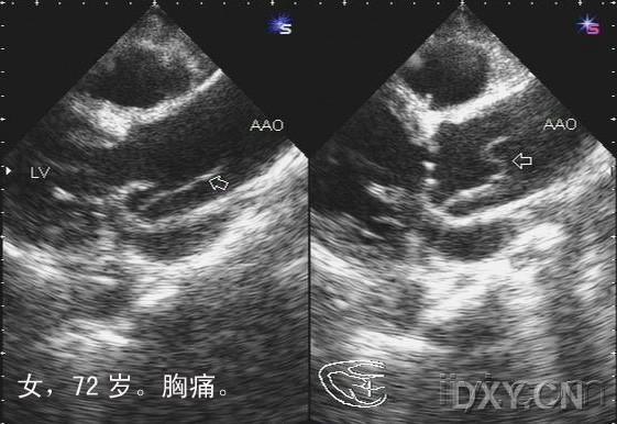 主动脉夹层 - 超声医学讨论版 - 爱爱医医学论坛