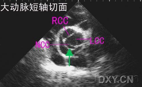 主动脉夹层 - 超声医学讨论版 - 爱爱医医学论坛