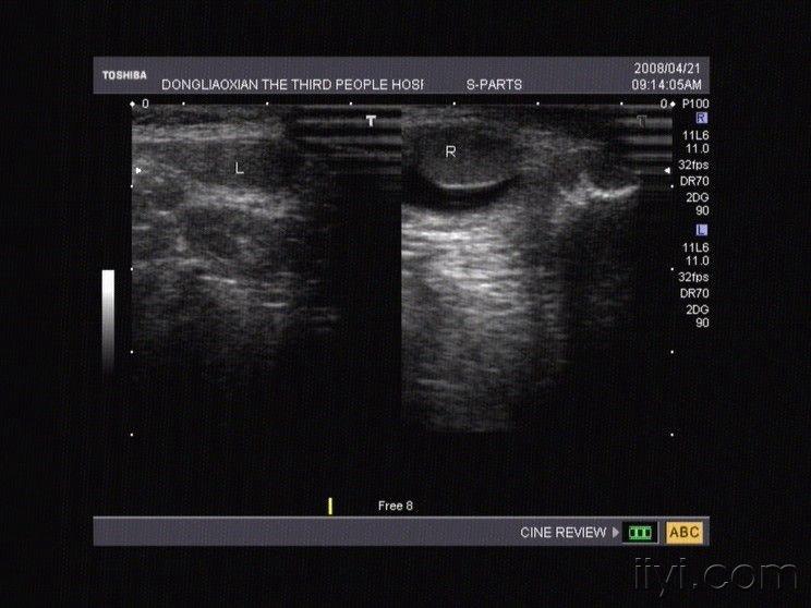 精索鞘膜积液 超声医学讨论版 爱爱医医学论坛