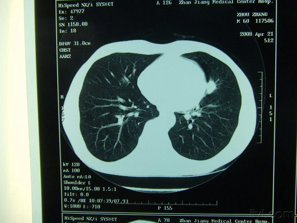 左肺舌段肿物性质待查,结核?肺癌?
