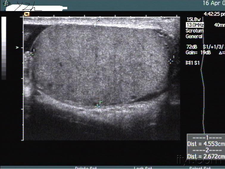 睾丸炎 体积饱满 回声不均