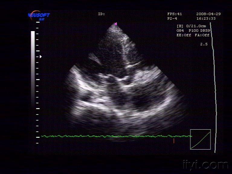 二尖瓣前叶脱垂 - 超声医学讨论版 - 爱爱医医学论坛