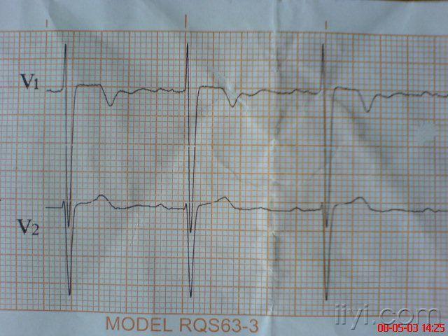 年轻人心电图出现qs波可以诊断心梗吗