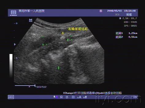 【专题】输尿管梗阻超声检查方法(献给新手 图片整理中)