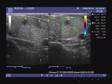 桥本氏甲状腺炎? - 超声医学讨论版