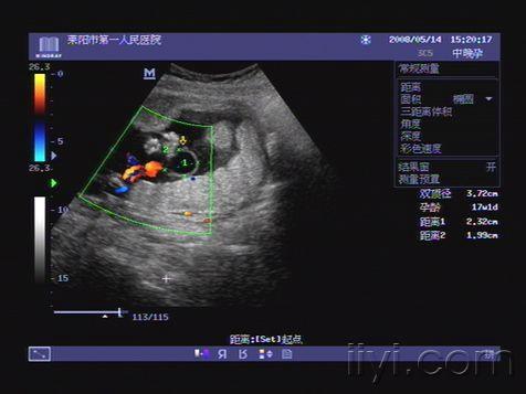 典型中孕胎儿脐带囊肿欣赏 超声医学讨论版 爱爱医医学论坛