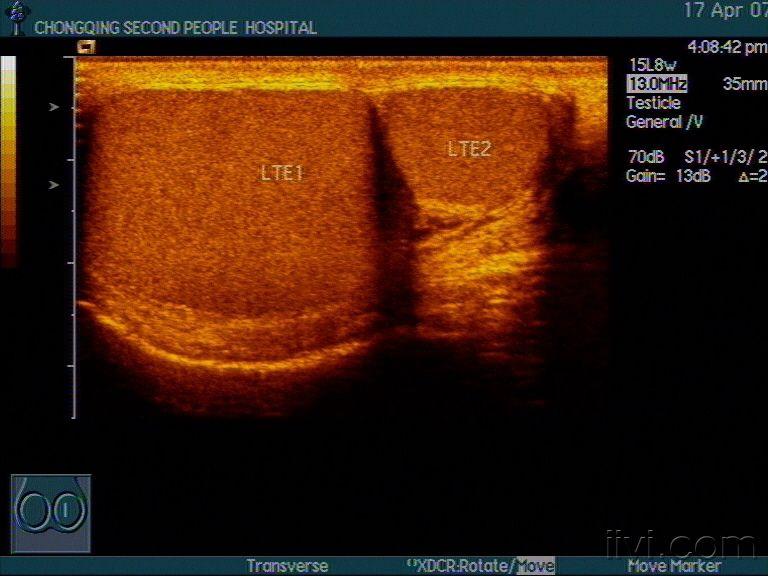 阴囊多睾症声像图