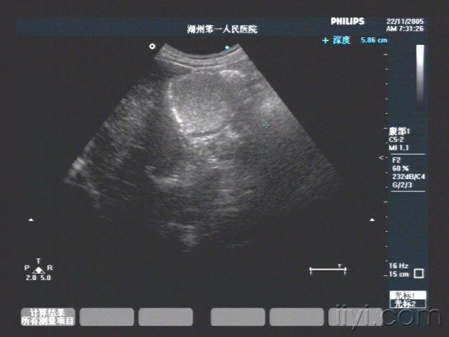 4-30 11:51 编辑   浙江省湖州市第一人民医院    彩超检查报告单