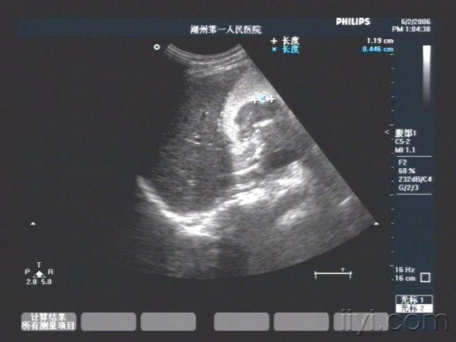 胃窦部胃壁增厚伴胃溃疡,提示mt 超声医学讨论版 爱爱医医学论坛