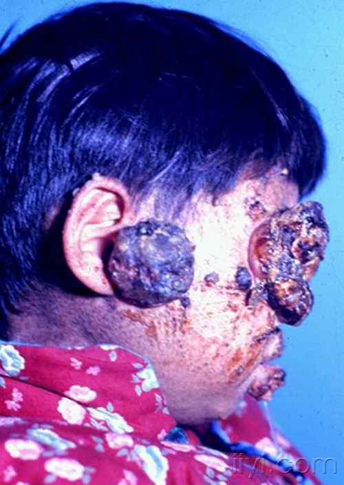 多** xeroderma pigmentosum着色性干皮病