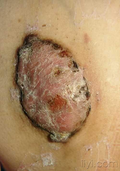 隆突皮肤纤维肉瘤3.jpg
