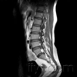 骶尾椎椎管内病变新增mri图片请看