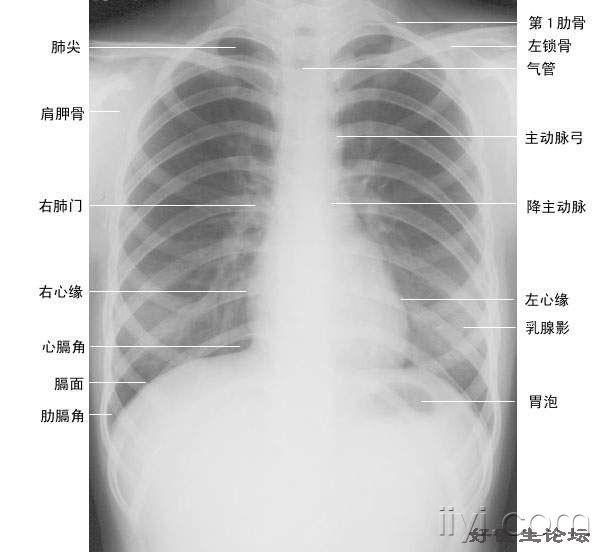 正常后前位胸片