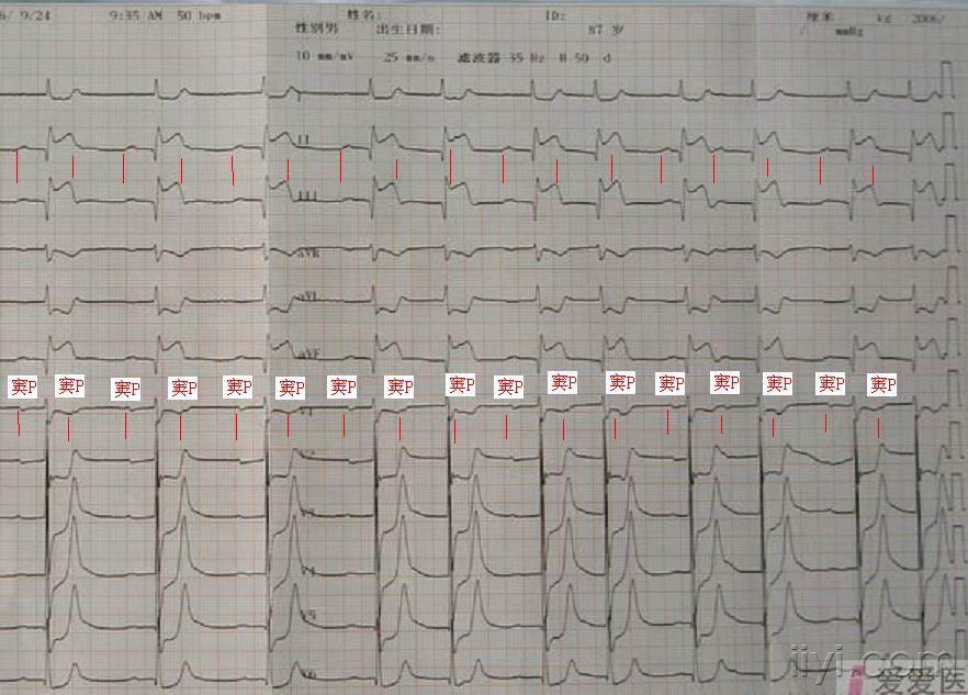 窦速,二度i型avb心电图