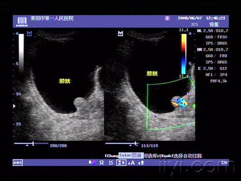 典型前列腺增生症超声图片