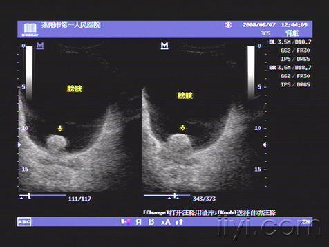 典型前列腺增生症超声图片