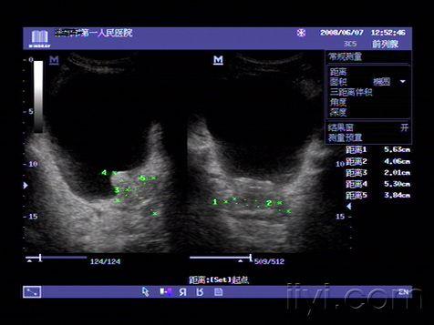 典型前列腺增生症超声图片