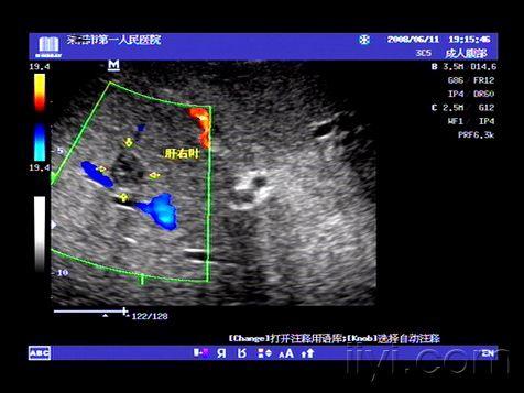 典型肝脏毛细血管瘤声像图