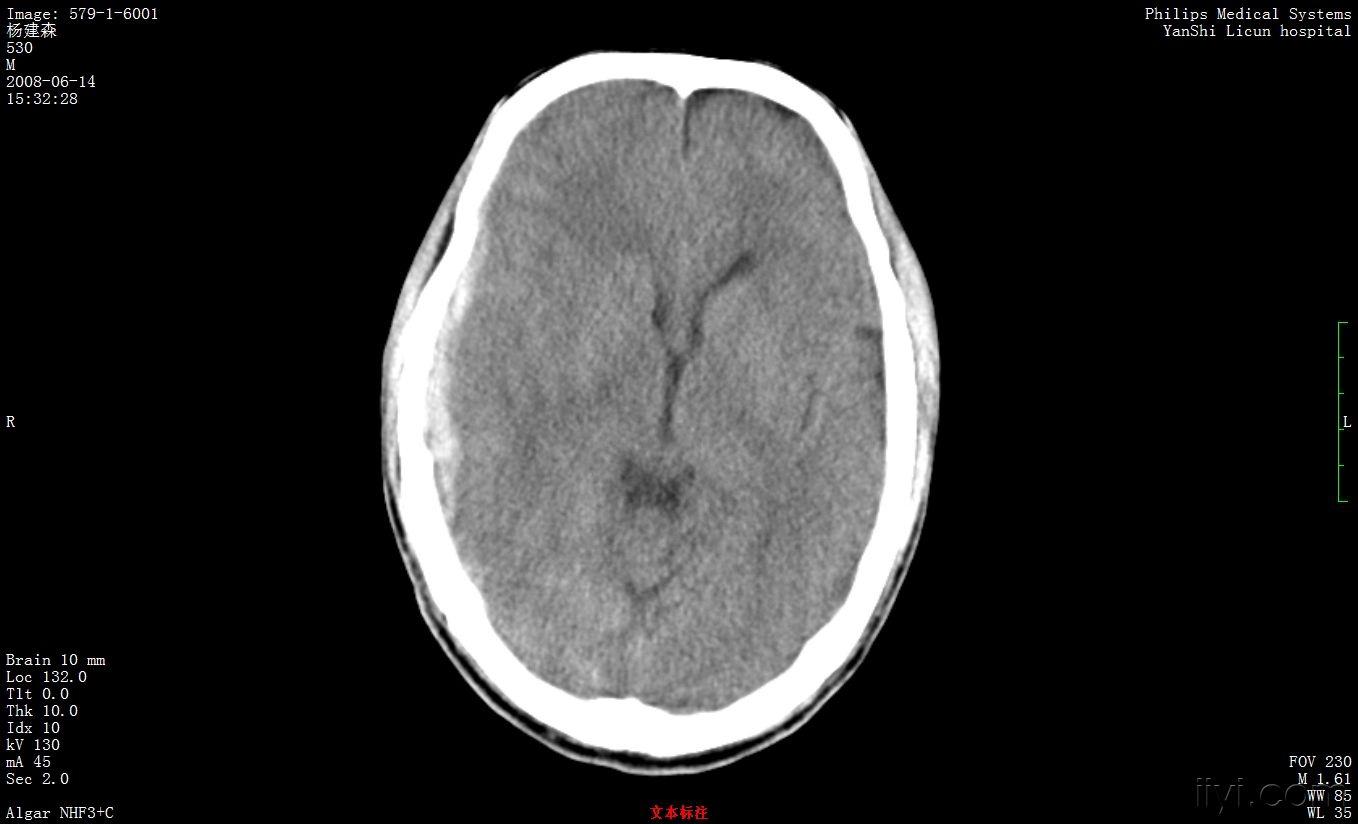 右侧颞枕顶部硬膜下血肿 - 医学影像学讨论版 - 爱爱