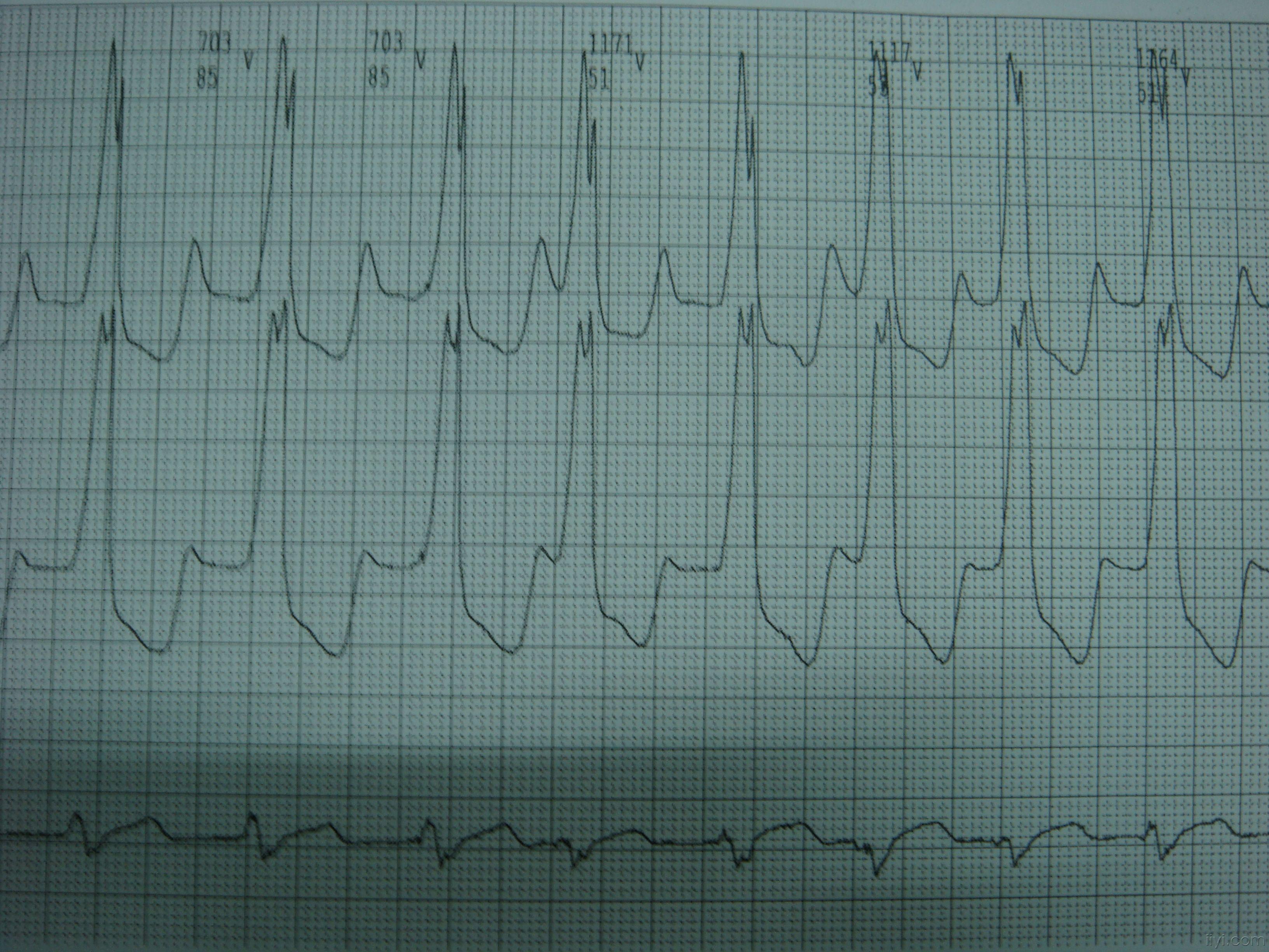 室速还是室上速 心电图脑电图专业讨论版 爱爱医医学论坛