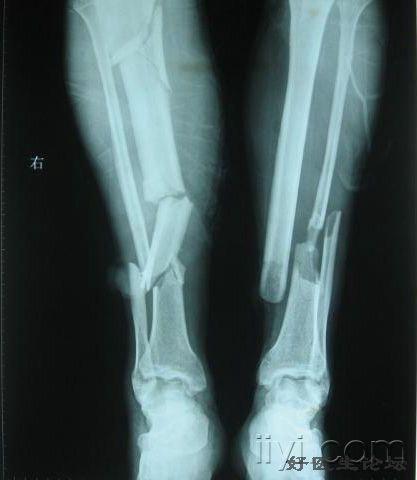 69 胫骨多段骨折,治疗方法   双侧胫腓骨骨折,右侧胫骨为多段骨折