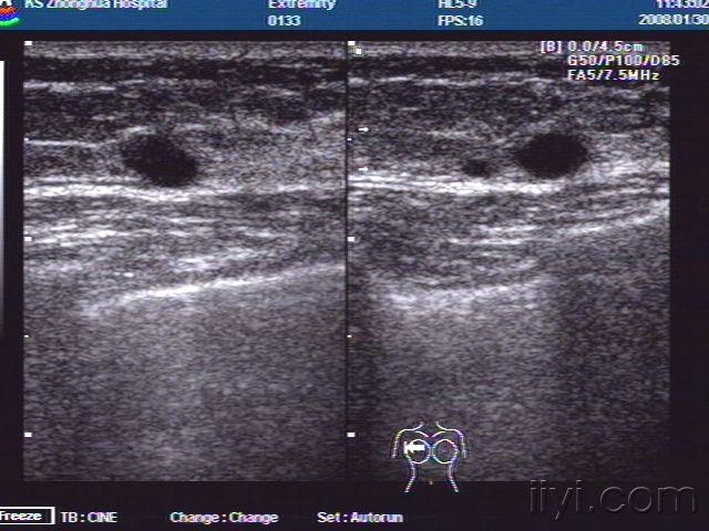 超然经典病例之——右侧乳腺内囊性肿物并双侧腋窝实性肿物