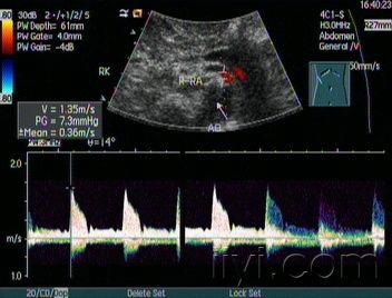 肾动脉狭窄声像图 - 超声医学讨论版 - 爱爱医医学论坛