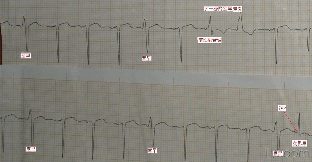 一份集室早.预激于一体的心电图?